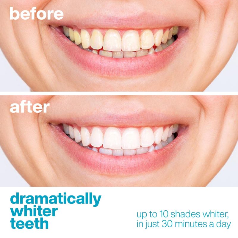 AquaSonic Whitening Strips 5